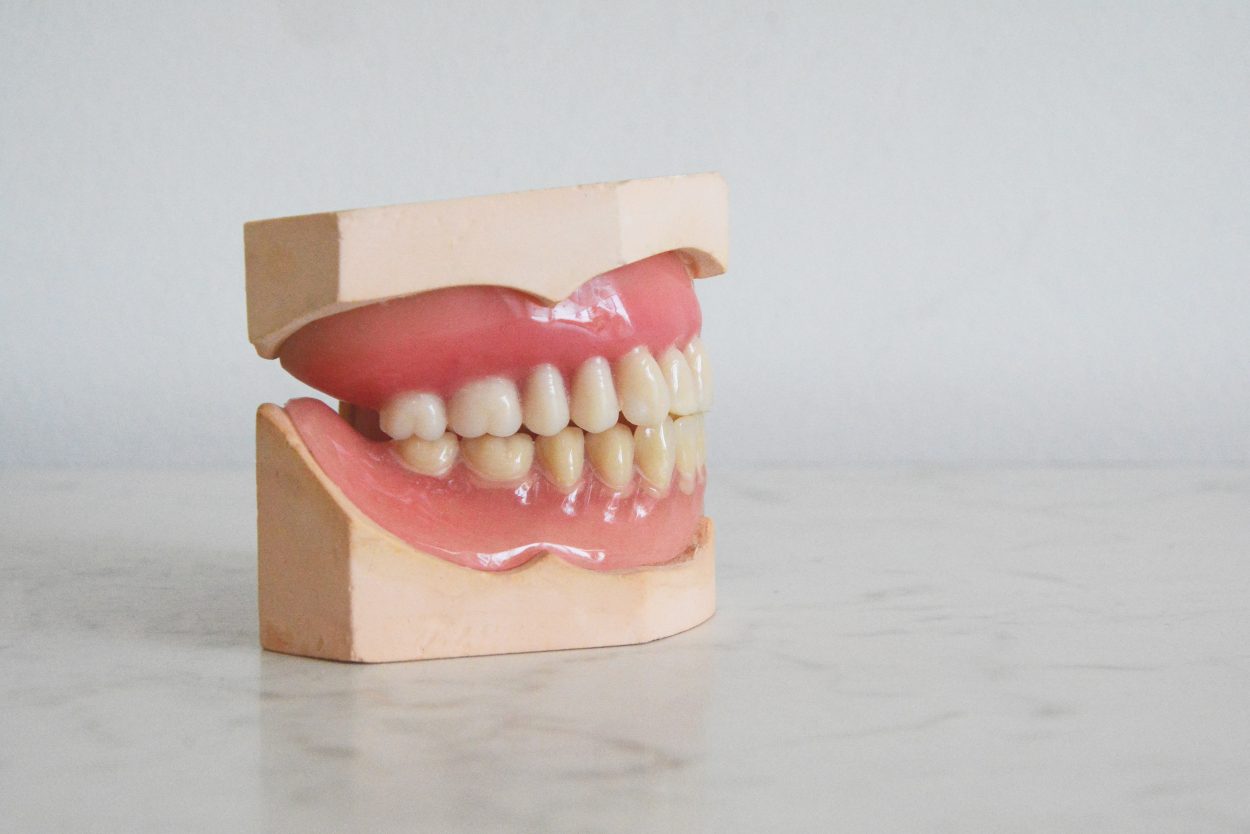 A picture of a typical dental cast.
